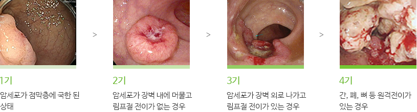 1기:암세포가 점막층에 국한 된 상태, 2기:암세포가 장벽 내에 머물고 림프절 전이가 없는 경우, 3기:암세포가 장벽 외로 나가고 림프절 전이가 있는 경우, 4기 간, 폐, 벼 등 원격전이가 있는 경우