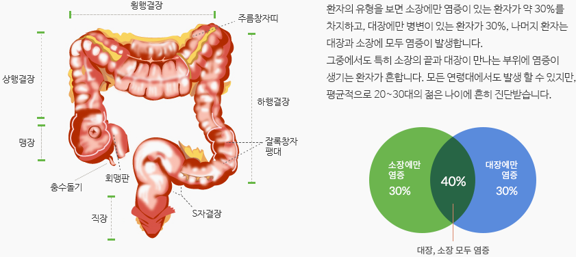 환자의 유형을 보면 소장에만 염증이 있는 환자가 약 30%를 차지하고, 대장에만 병변이 있는 환자가 30%, 나머지 환자는 대장과 소장에 모두 염증이 발생합니다. 그중에서도 특히 소장의 끝과 대장이 만나는 부위에 염증이 생기는 환자가 흔합니다. 모든 연령대에서도 발생 할 수 있지만, 평균적으로 20~30대의 젊은 나이에 흔히 진단받습니다.